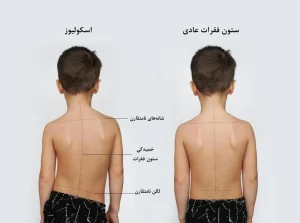 اسکولیوز