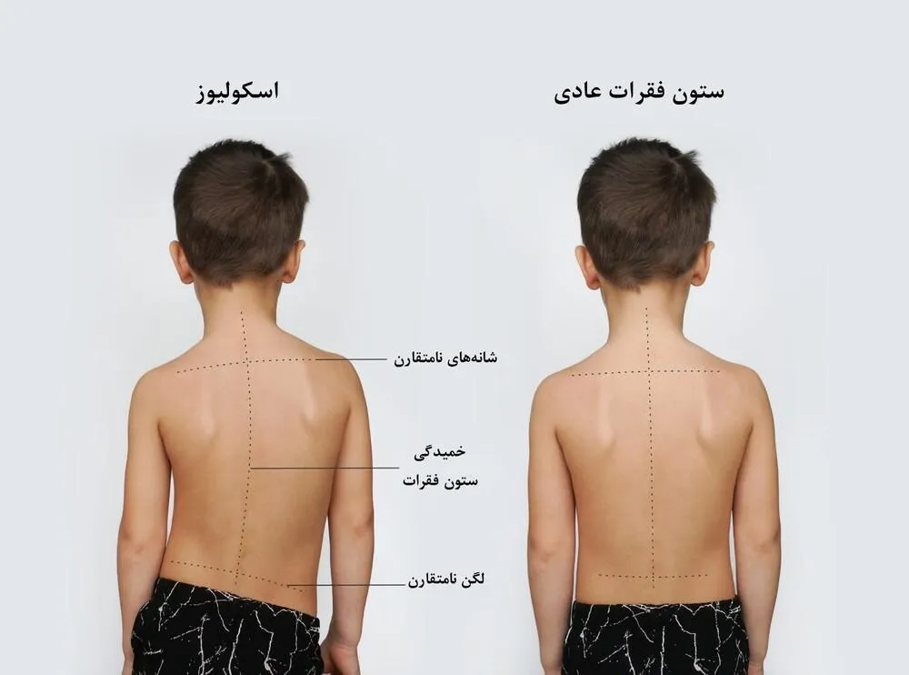 اسکولیوز